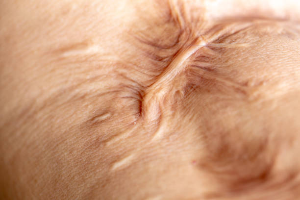 Изгаряния снимка