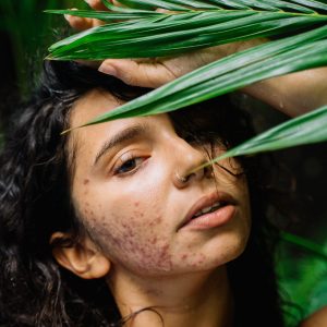 фотобиомодулация при акне и розацея