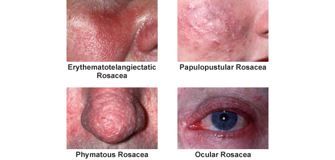 Four types Rosacea
